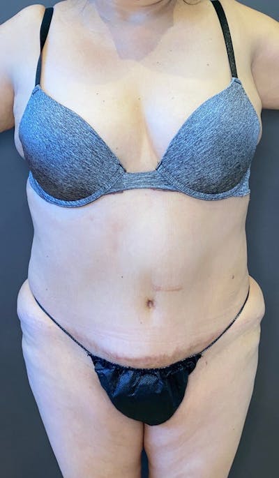 Tummy Tuck Before & After Gallery - Patient 151521121 - Image 1