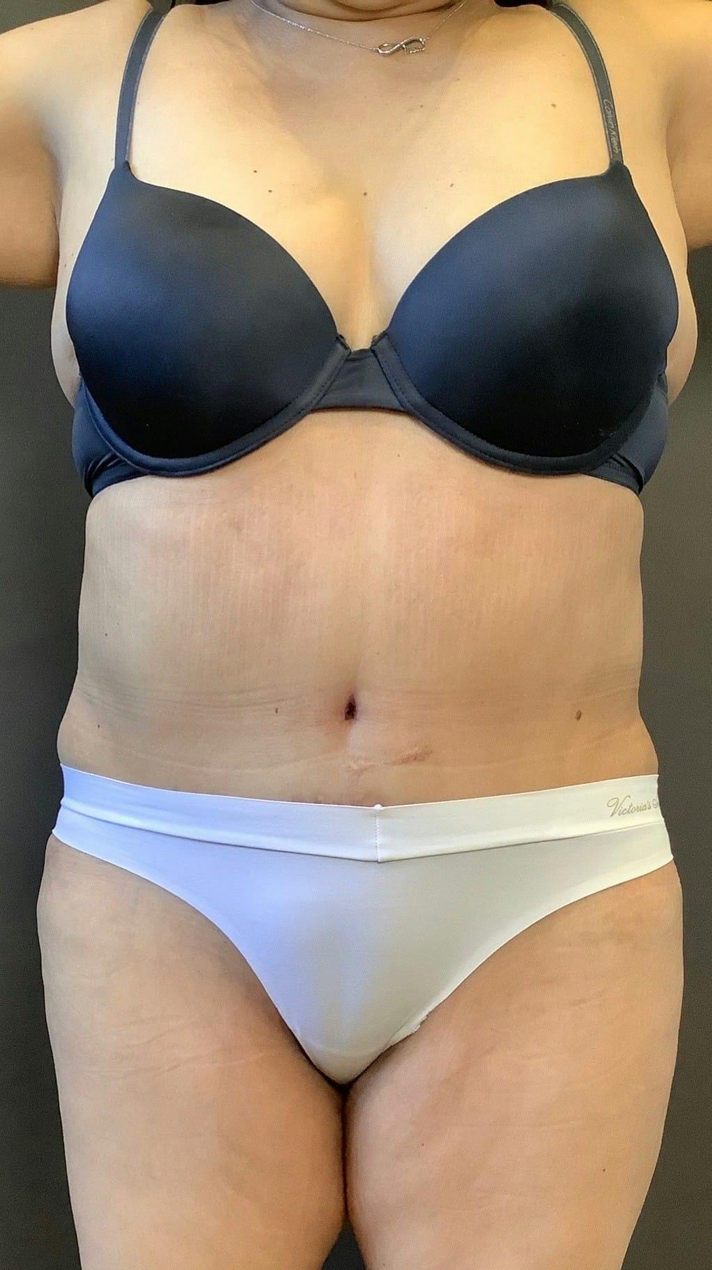 Tummy Tuck Before & After Gallery - Patient 151521121 - Image 2