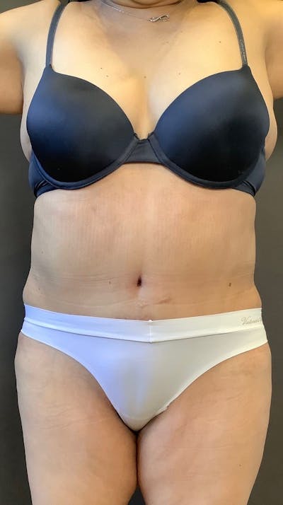 Tummy Tuck Before & After Gallery - Patient 151521121 - Image 2