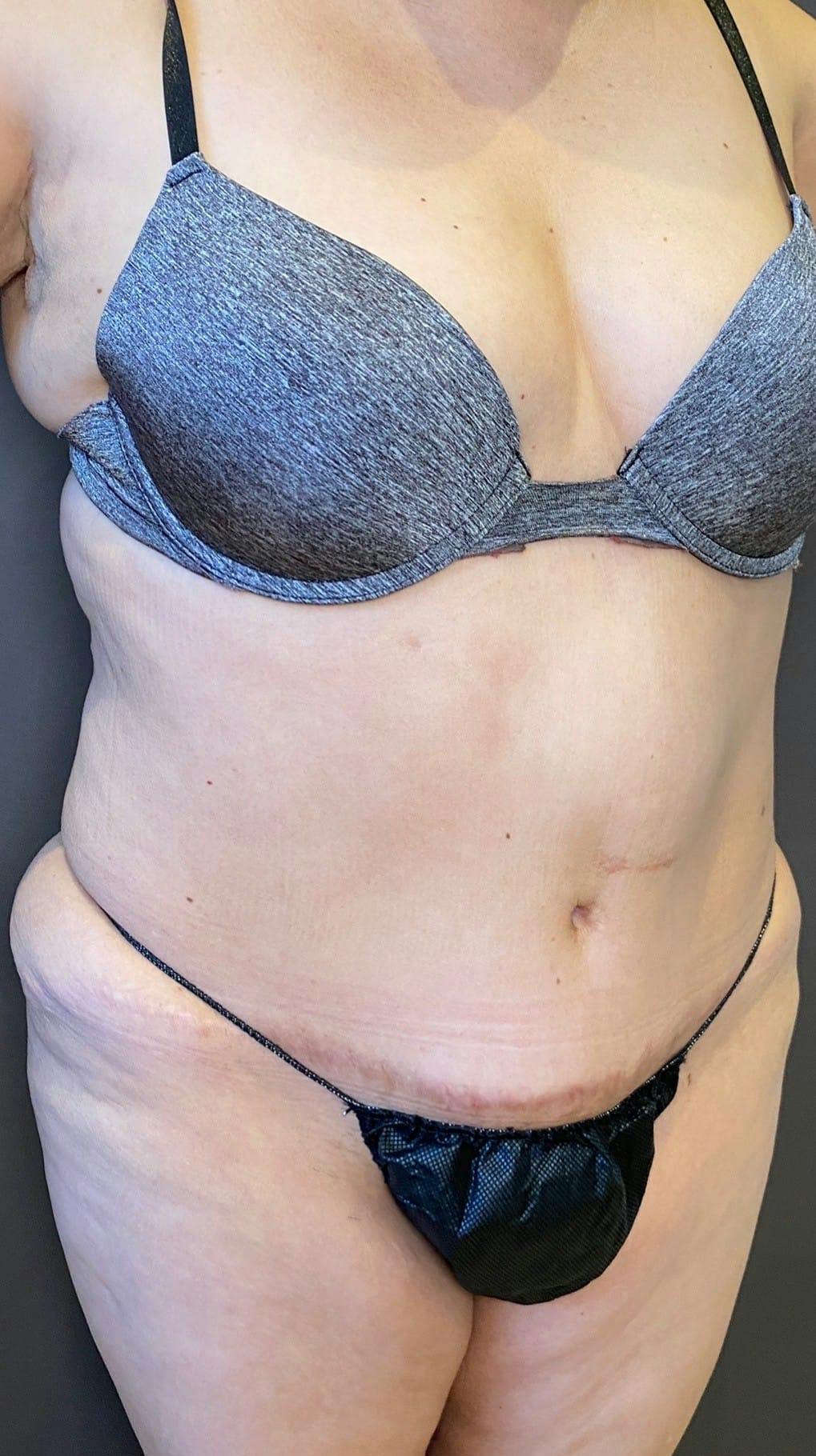 Tummy Tuck Before & After Gallery - Patient 151521121 - Image 3
