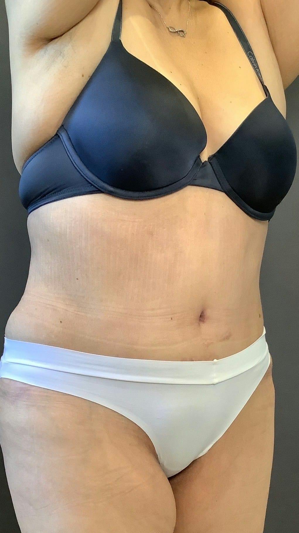 Tummy Tuck Before & After Gallery - Patient 151521121 - Image 4