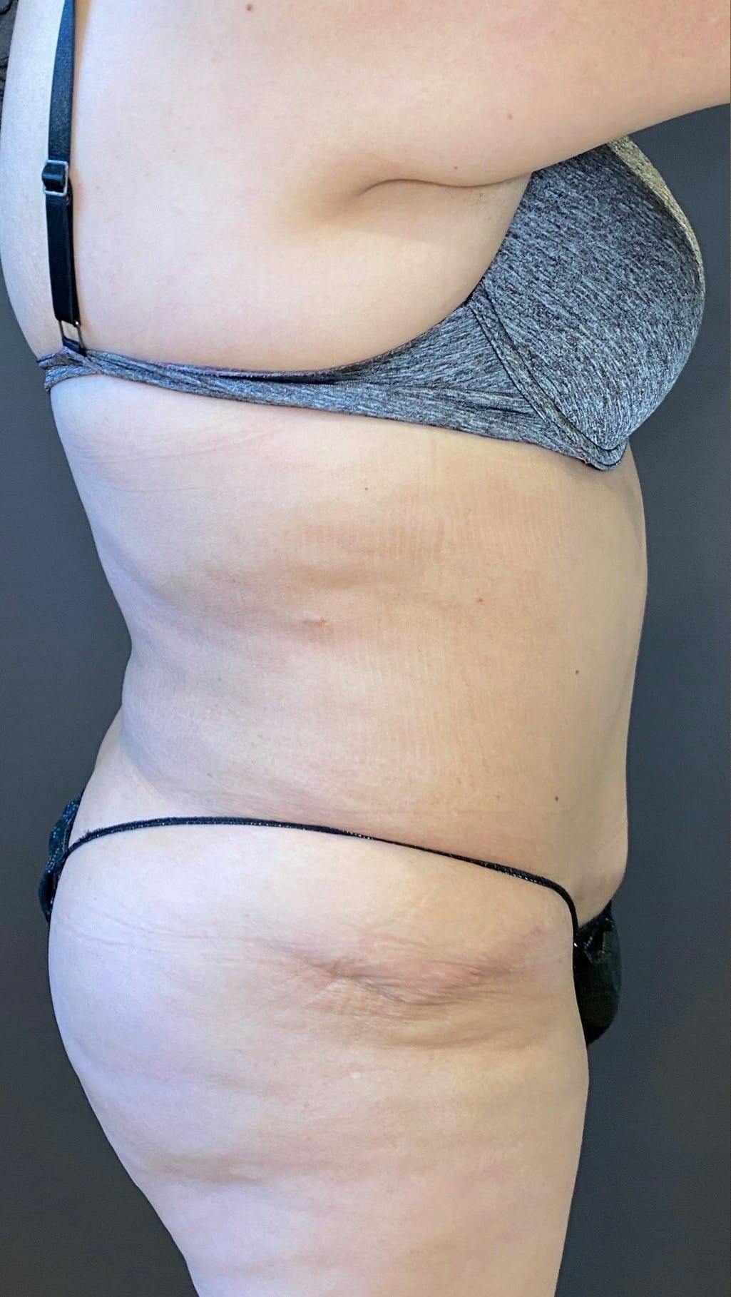 Tummy Tuck Before & After Gallery - Patient 151521121 - Image 5