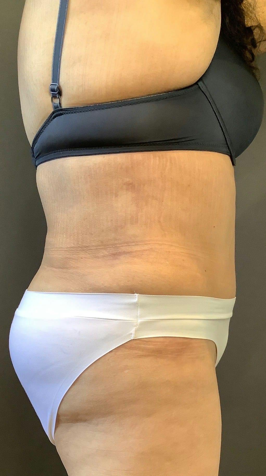 Tummy Tuck Before & After Gallery - Patient 151521121 - Image 6