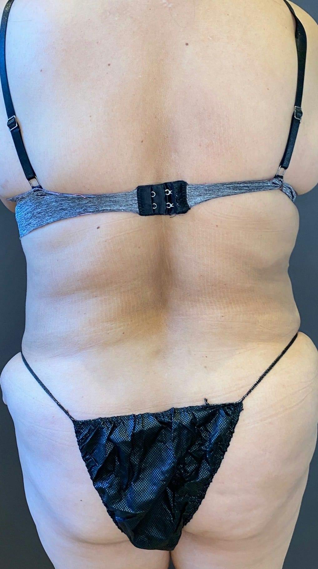 Tummy Tuck Before & After Gallery - Patient 151521121 - Image 7