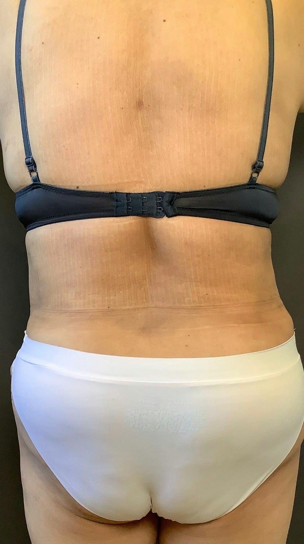Tummy Tuck Before & After Gallery - Patient 151521121 - Image 8