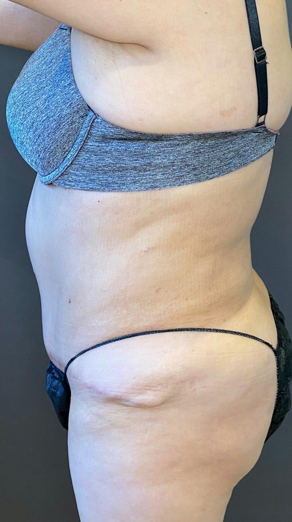 Tummy Tuck Before & After Gallery - Patient 151521121 - Image 9