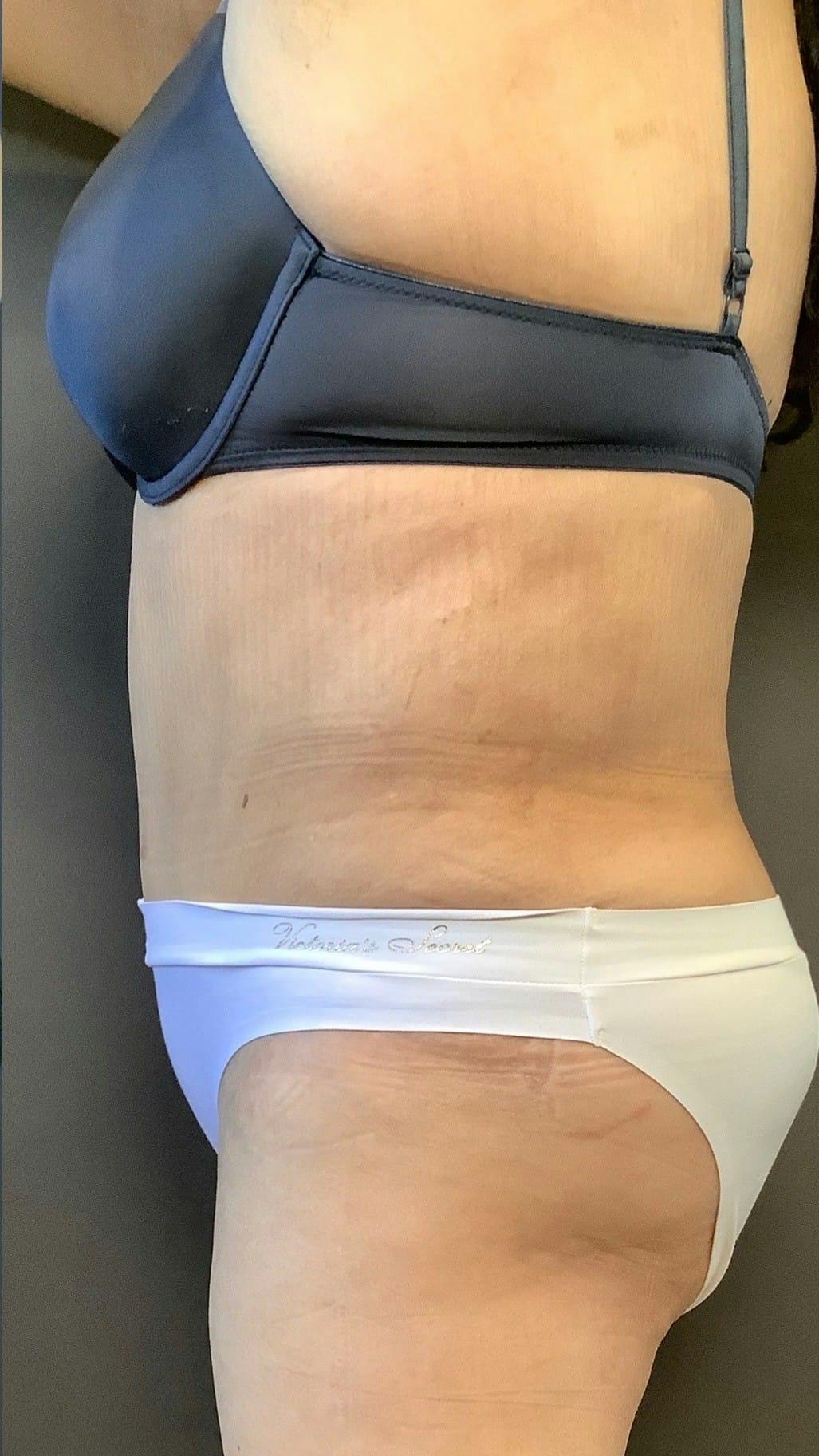 Tummy Tuck Before & After Gallery - Patient 151521121 - Image 10