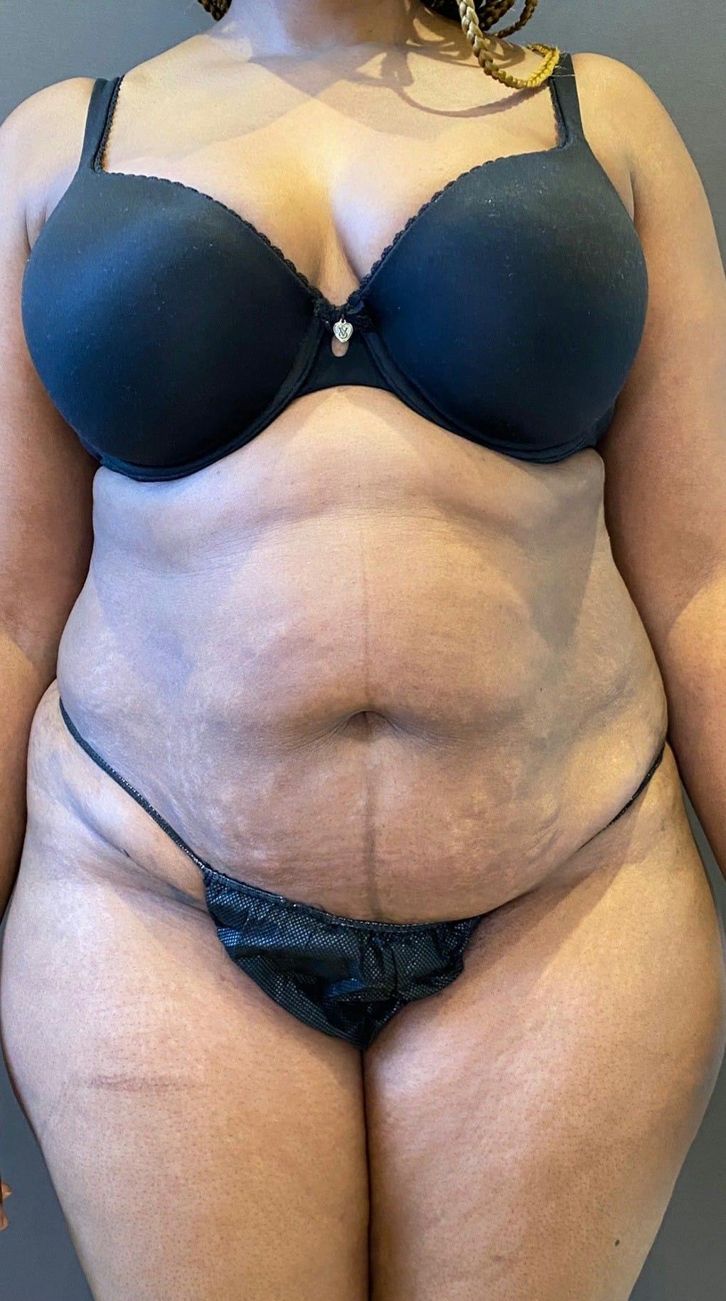 Tummy Tuck Before & After Gallery - Patient 151521122 - Image 1