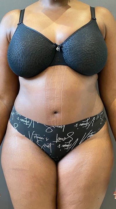 Tummy Tuck Before & After Gallery - Patient 151521122 - Image 2
