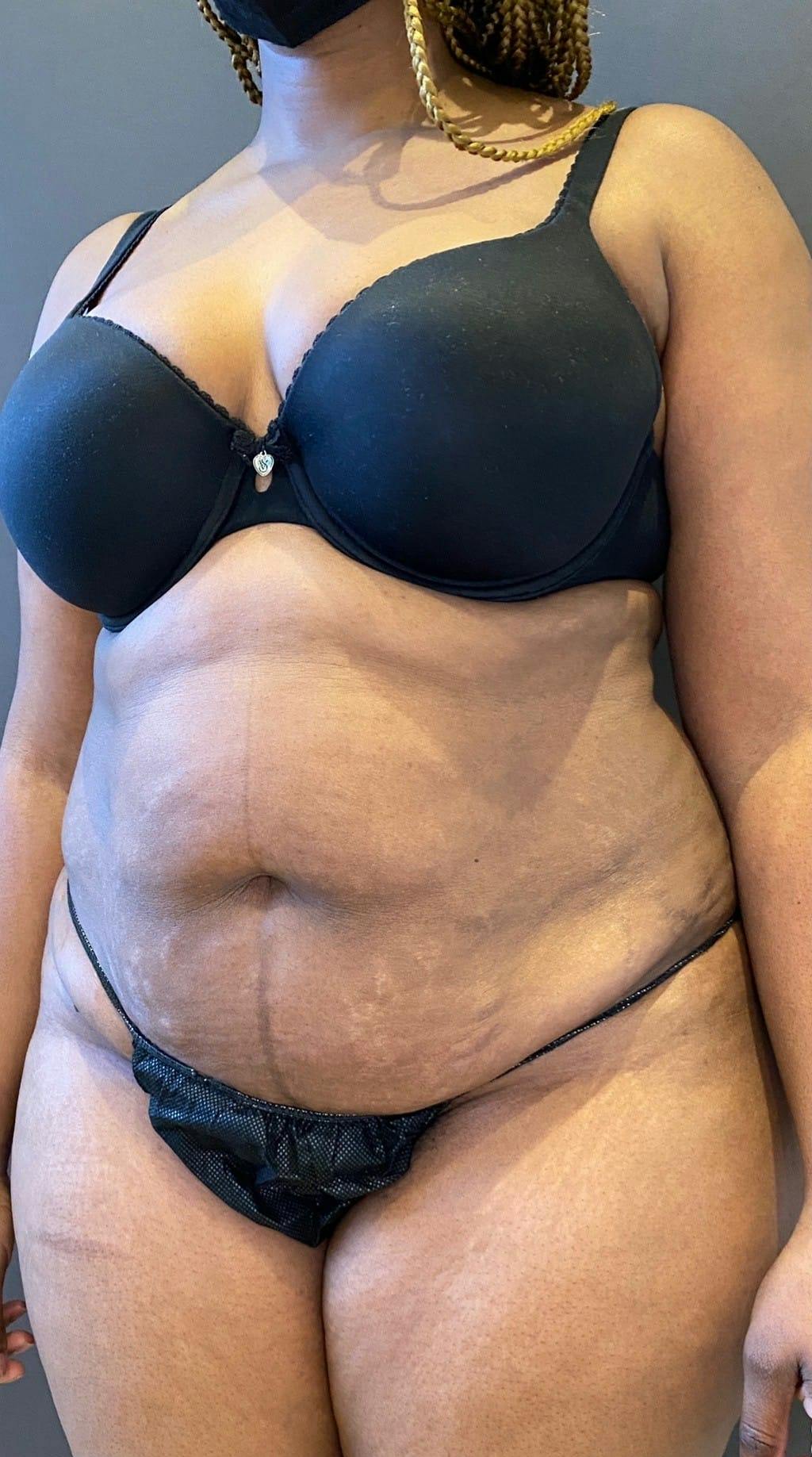 Tummy Tuck Before & After Gallery - Patient 151521122 - Image 3