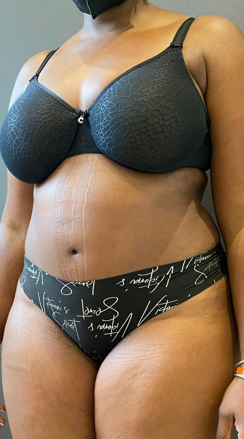 Tummy Tuck Before & After Gallery - Patient 151521122 - Image 4