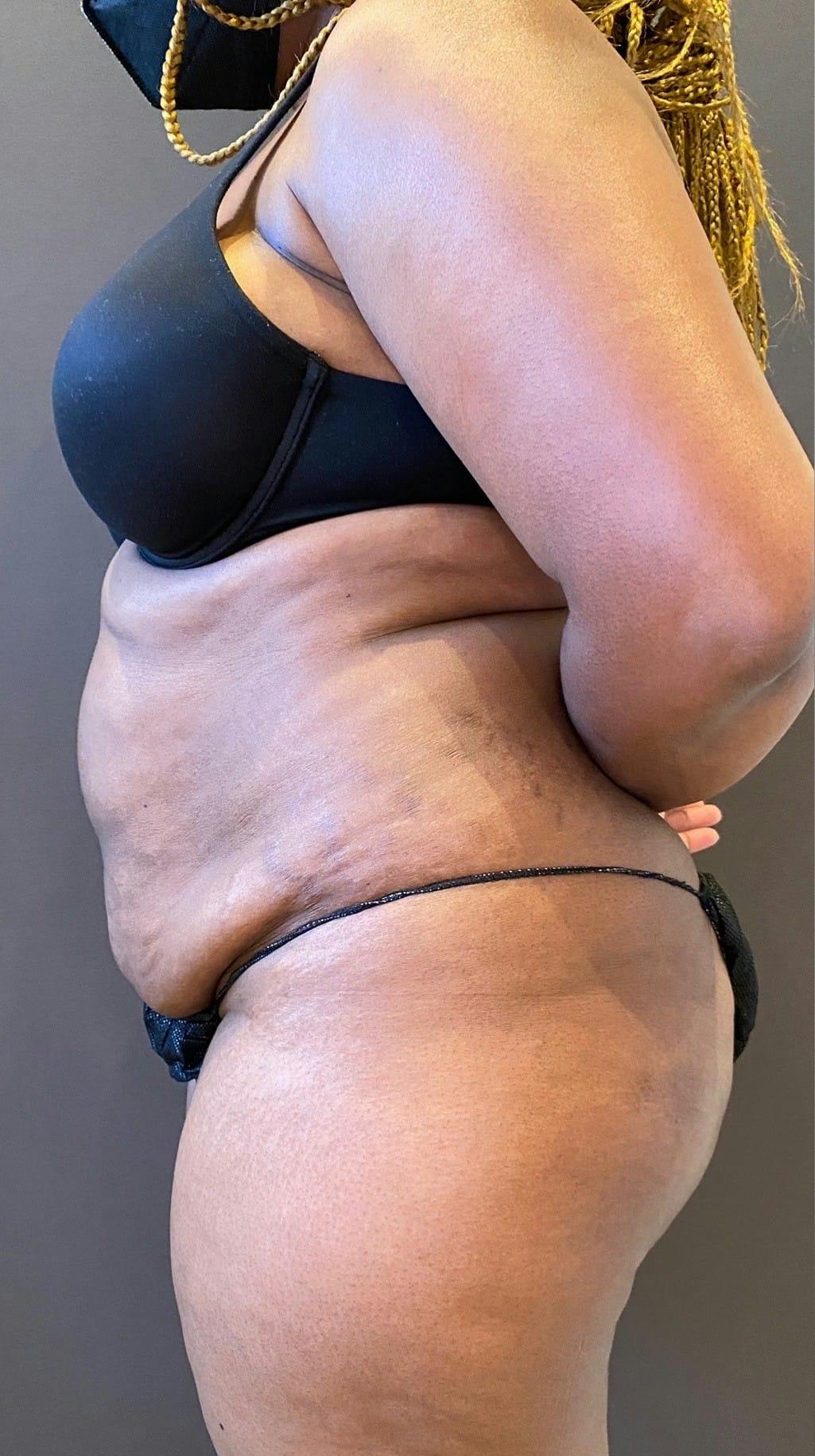 Tummy Tuck Before & After Gallery - Patient 151521122 - Image 5