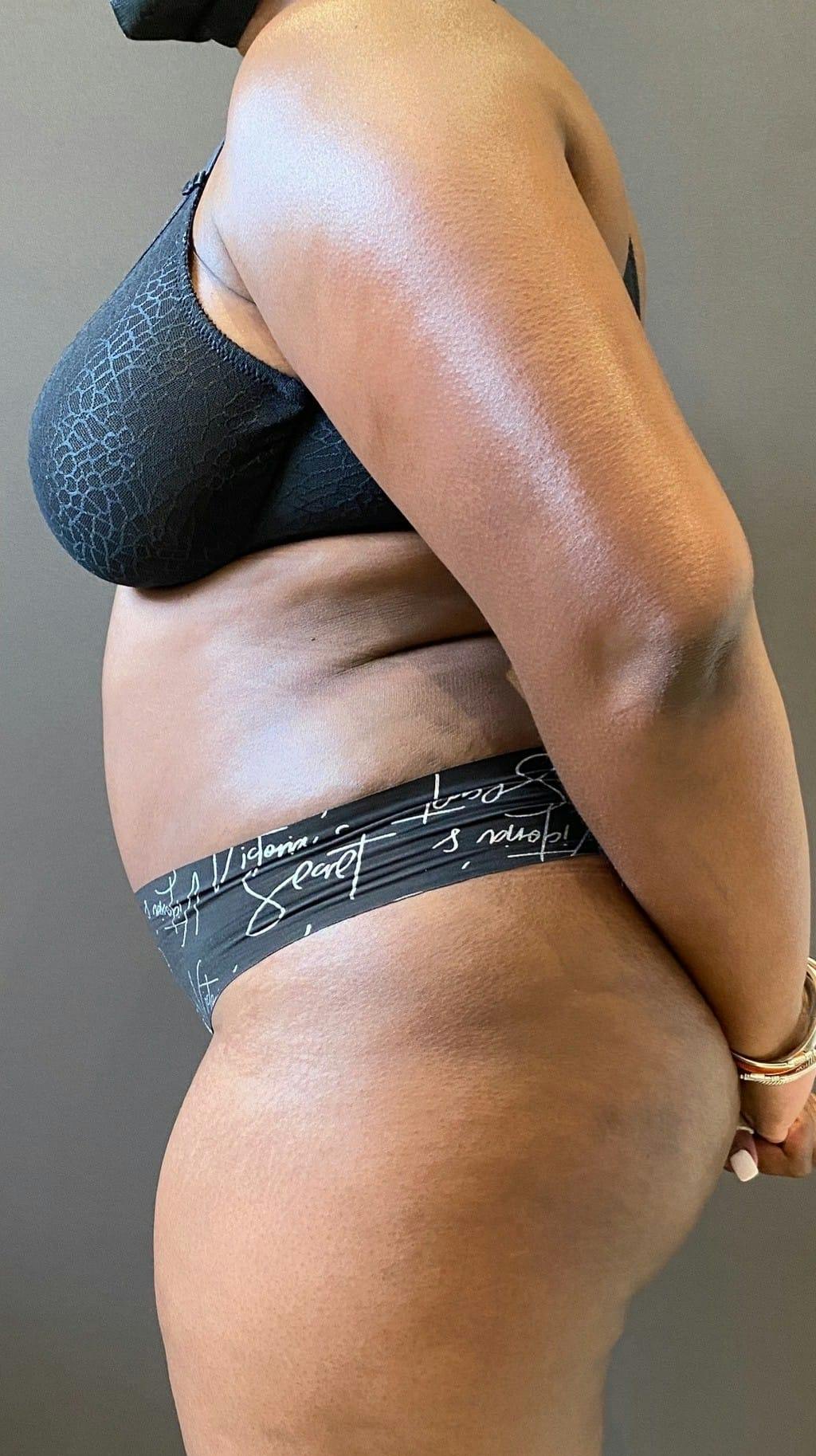 Tummy Tuck Before & After Gallery - Patient 151521122 - Image 6