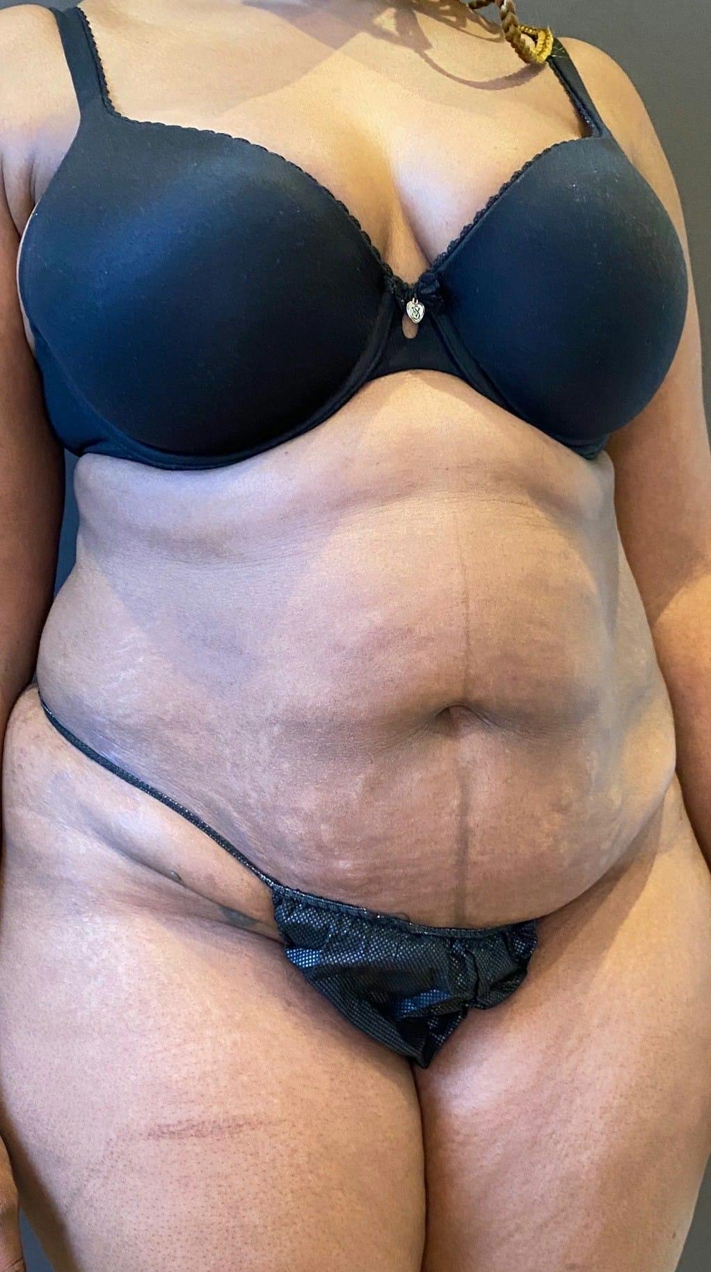 Tummy Tuck Before & After Gallery - Patient 151521122 - Image 7