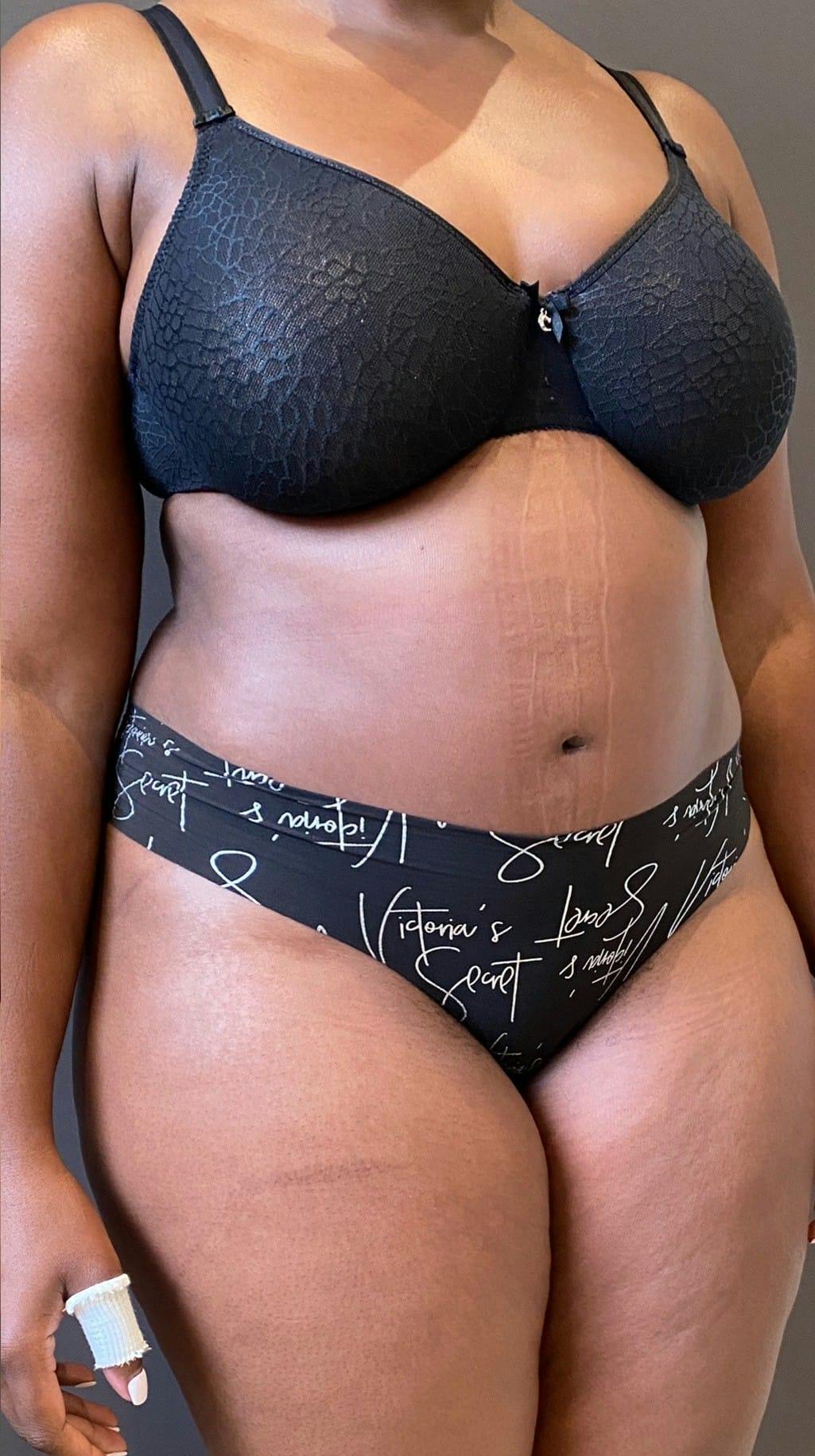 Tummy Tuck Before & After Gallery - Patient 151521122 - Image 8