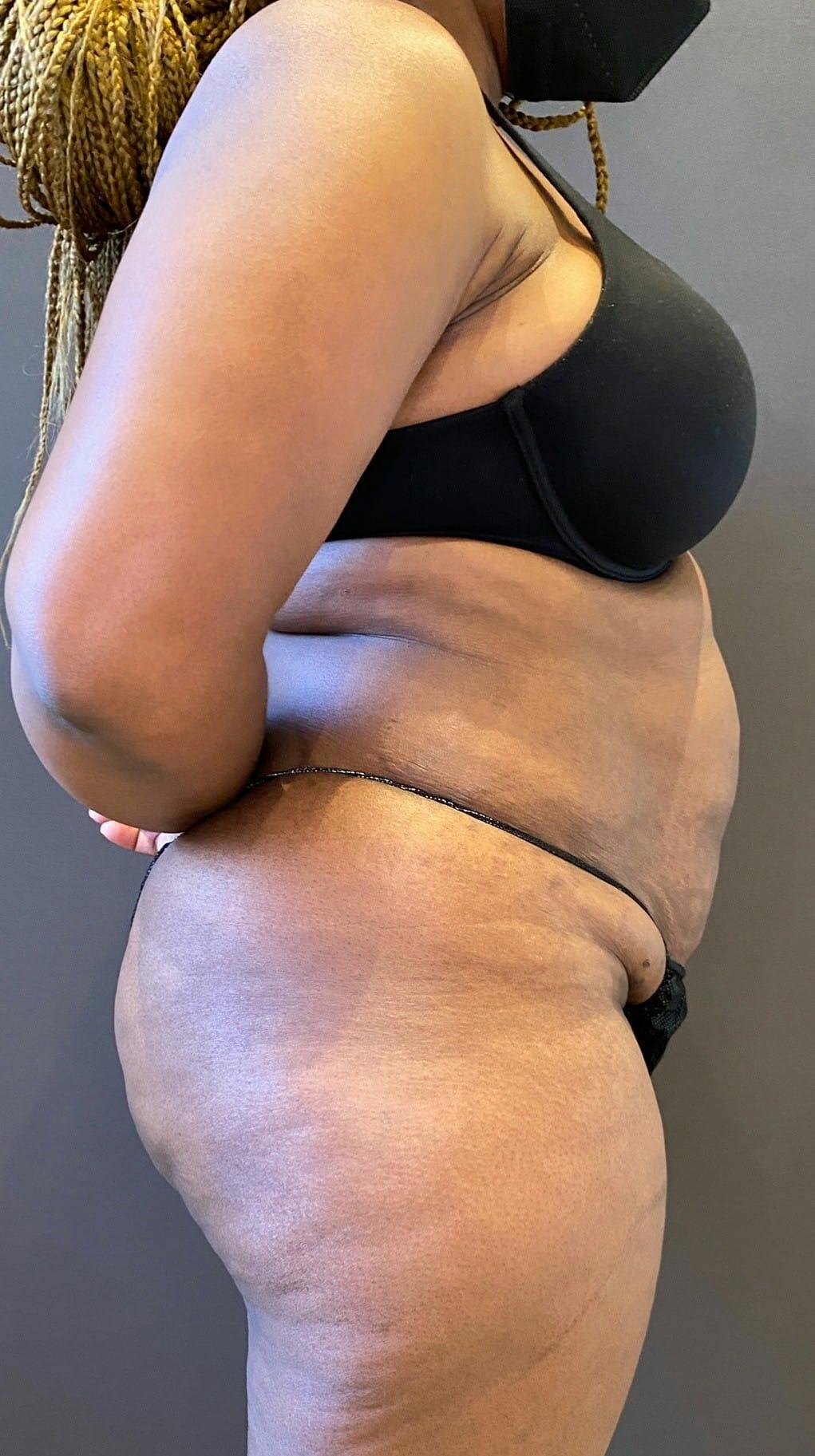 Tummy Tuck Before & After Gallery - Patient 151521122 - Image 9