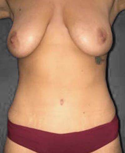 Tummy Tuck Before & After Gallery - Patient 151521123 - Image 2