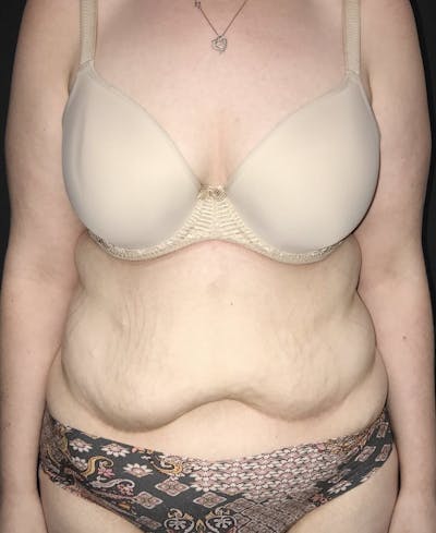Tummy Tuck Before & After Gallery - Patient 151521124 - Image 1