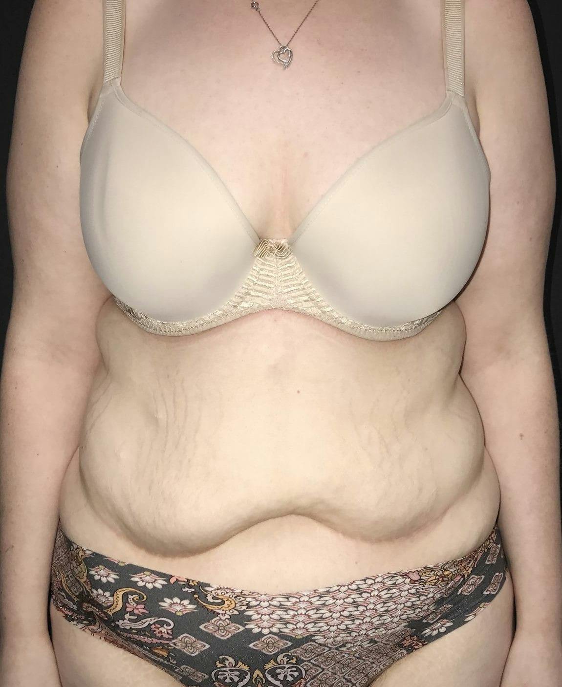 Tummy Tuck Before & After Gallery - Patient 151521124 - Image 1