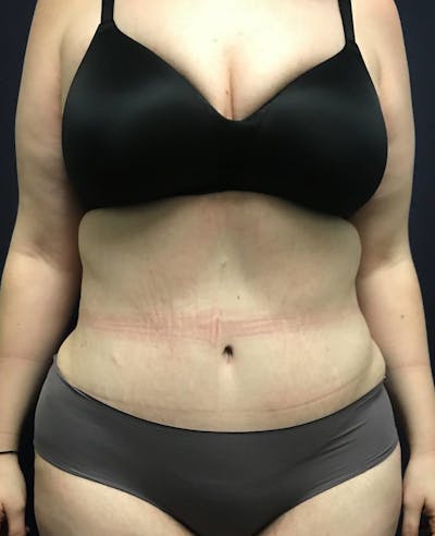 Tummy Tuck Before & After Gallery - Patient 151521124 - Image 2