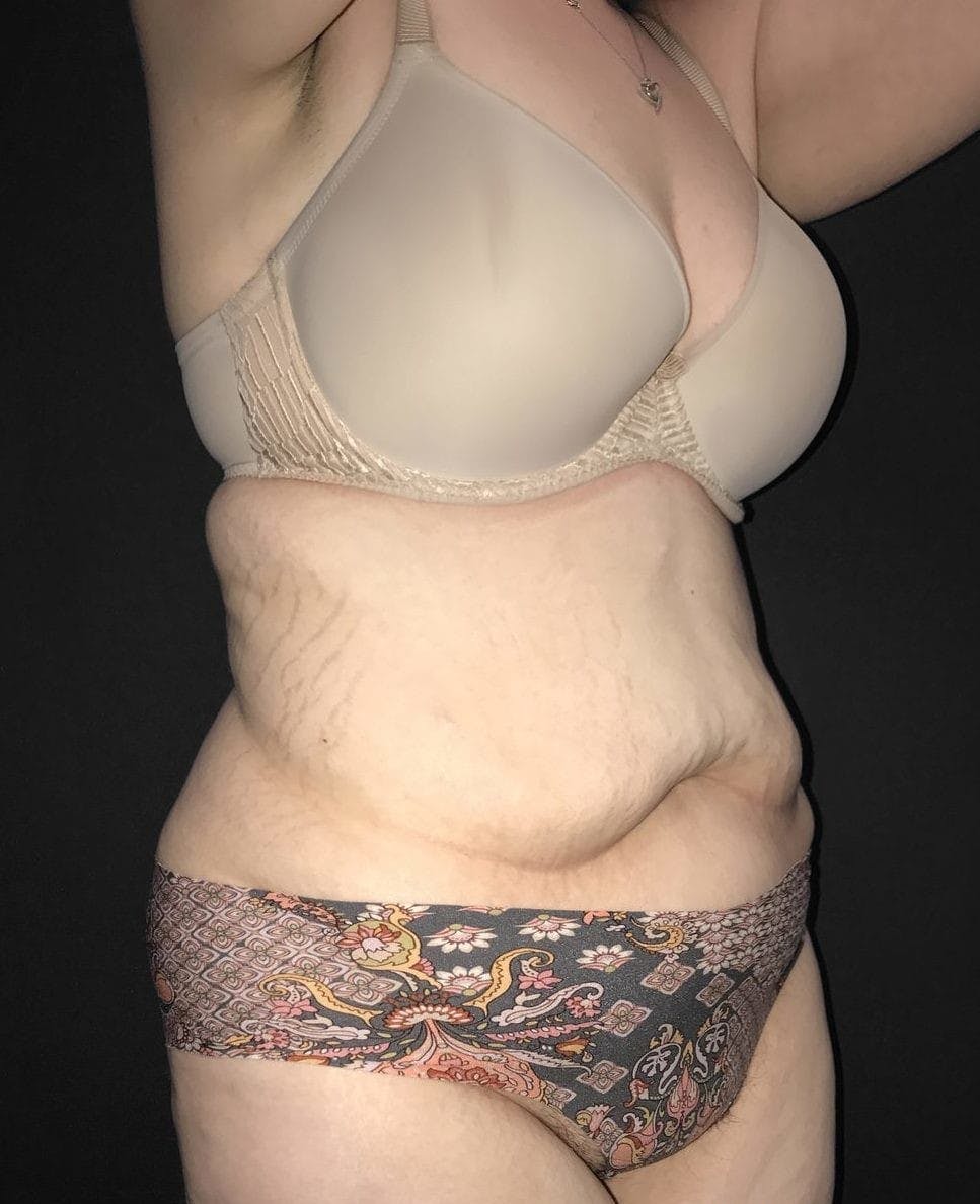 Tummy Tuck Before & After Gallery - Patient 151521124 - Image 3