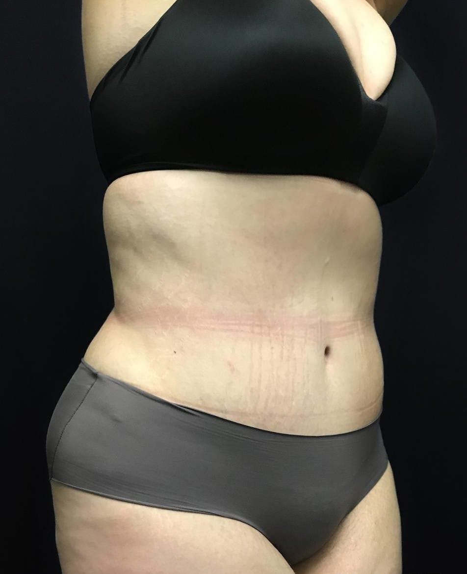 Tummy Tuck Before & After Gallery - Patient 151521124 - Image 4