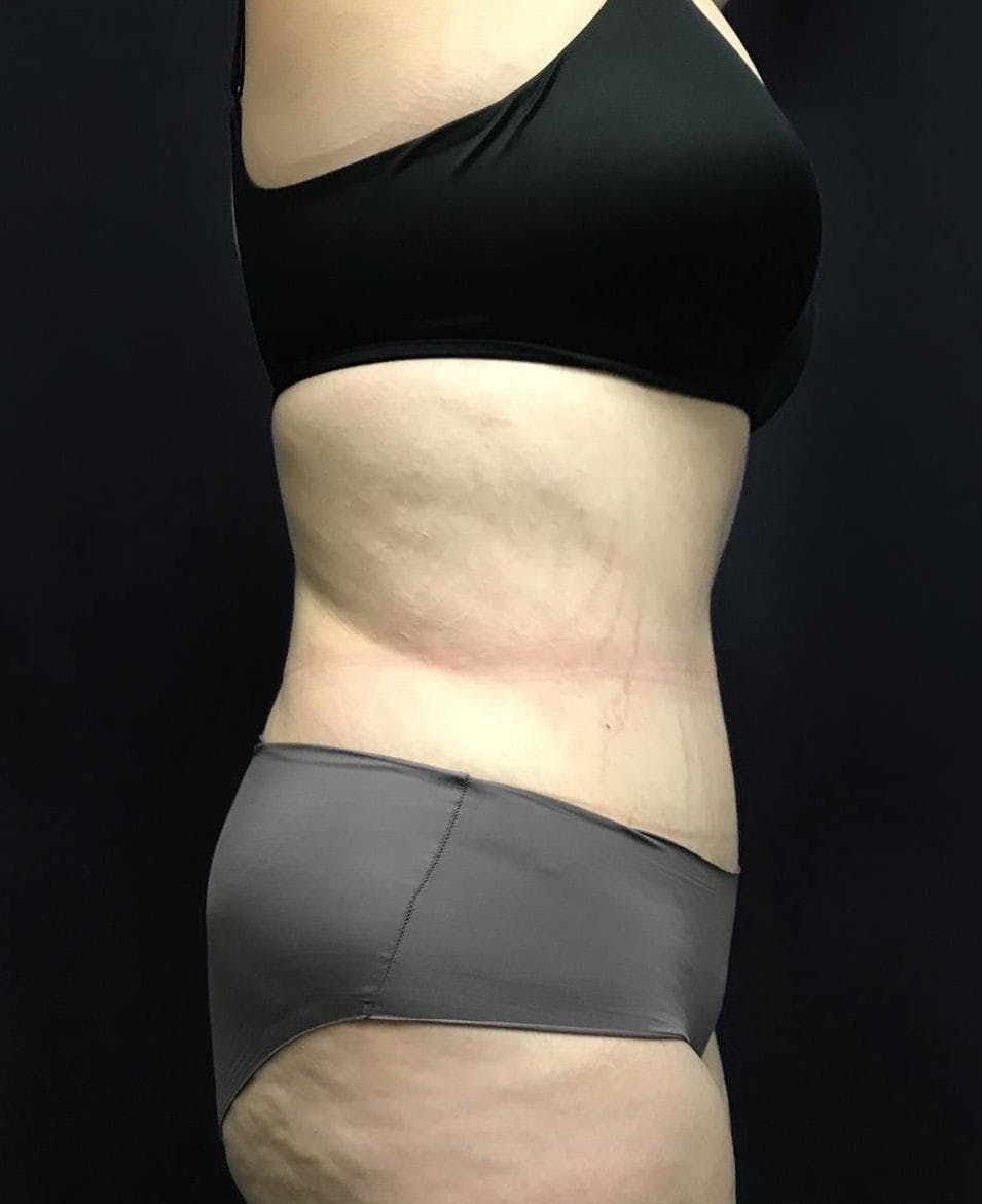 Tummy Tuck Before & After Gallery - Patient 151521124 - Image 6