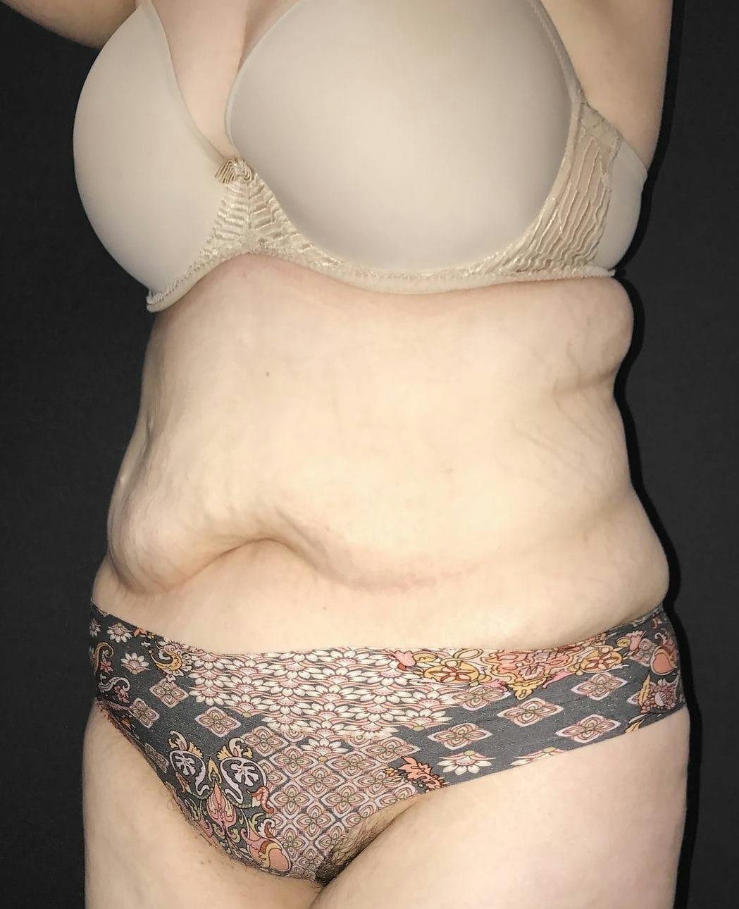 Tummy Tuck Before & After Gallery - Patient 151521124 - Image 7