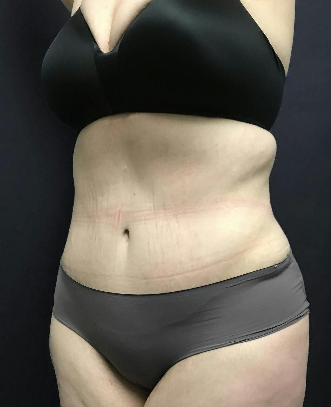 Tummy Tuck Before & After Gallery - Patient 151521124 - Image 8