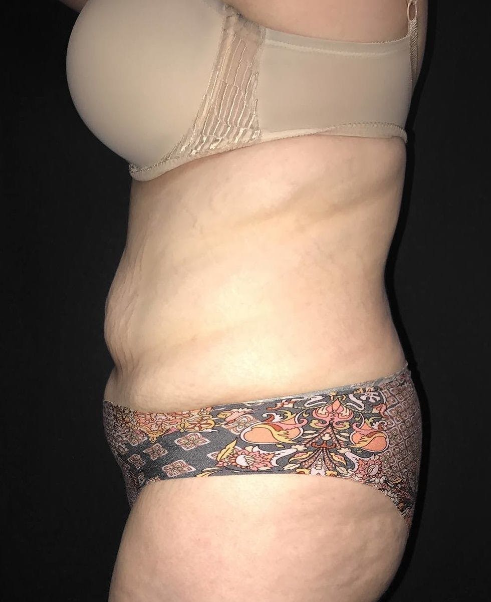 Tummy Tuck Before & After Gallery - Patient 151521124 - Image 9