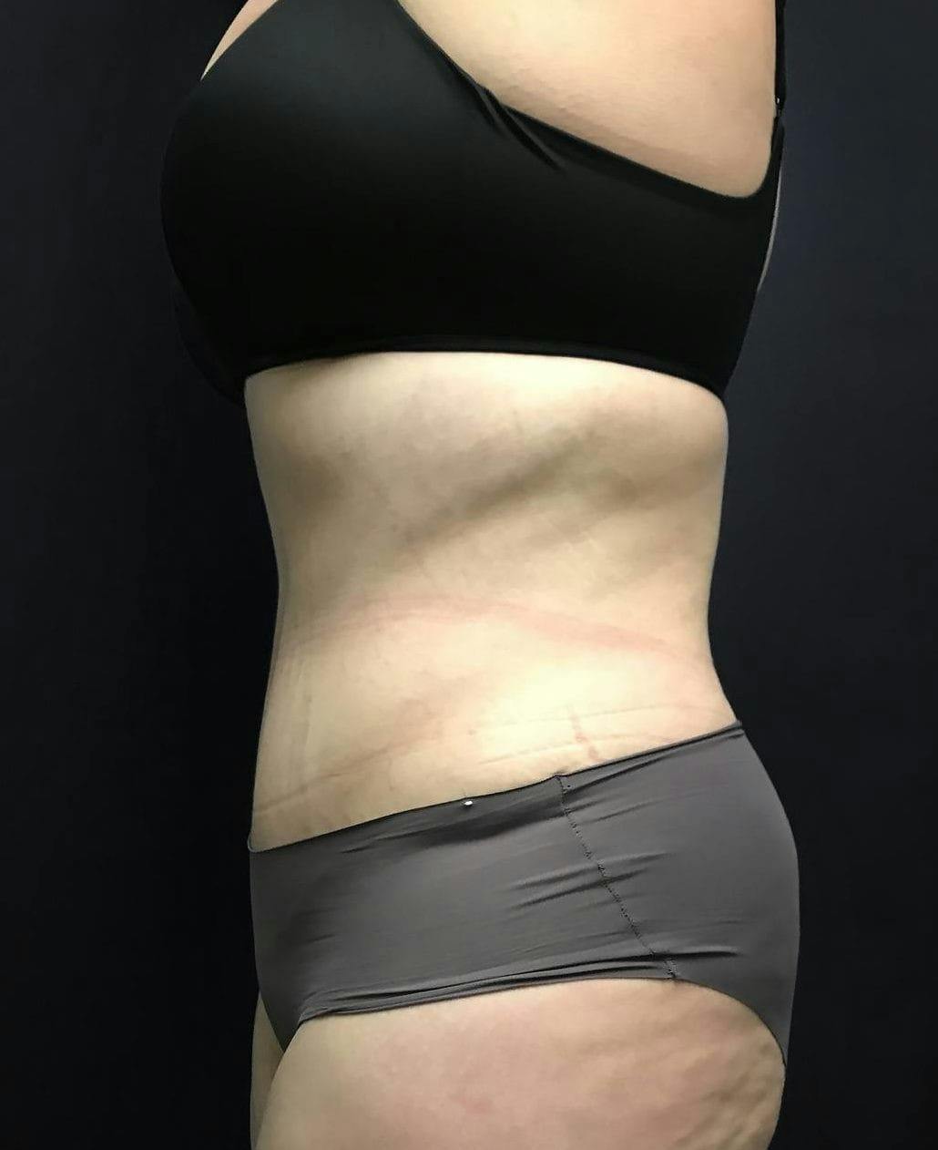 Tummy Tuck Before & After Gallery - Patient 151521124 - Image 10
