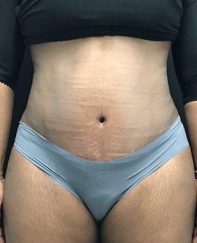 Tummy Tuck Before & After Gallery - Patient 151521125 - Image 2