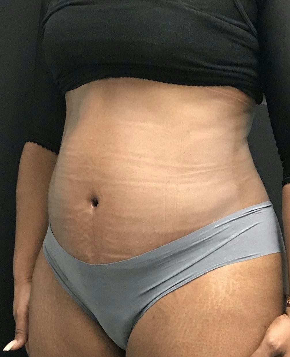 Tummy Tuck Before & After Gallery - Patient 151521125 - Image 4