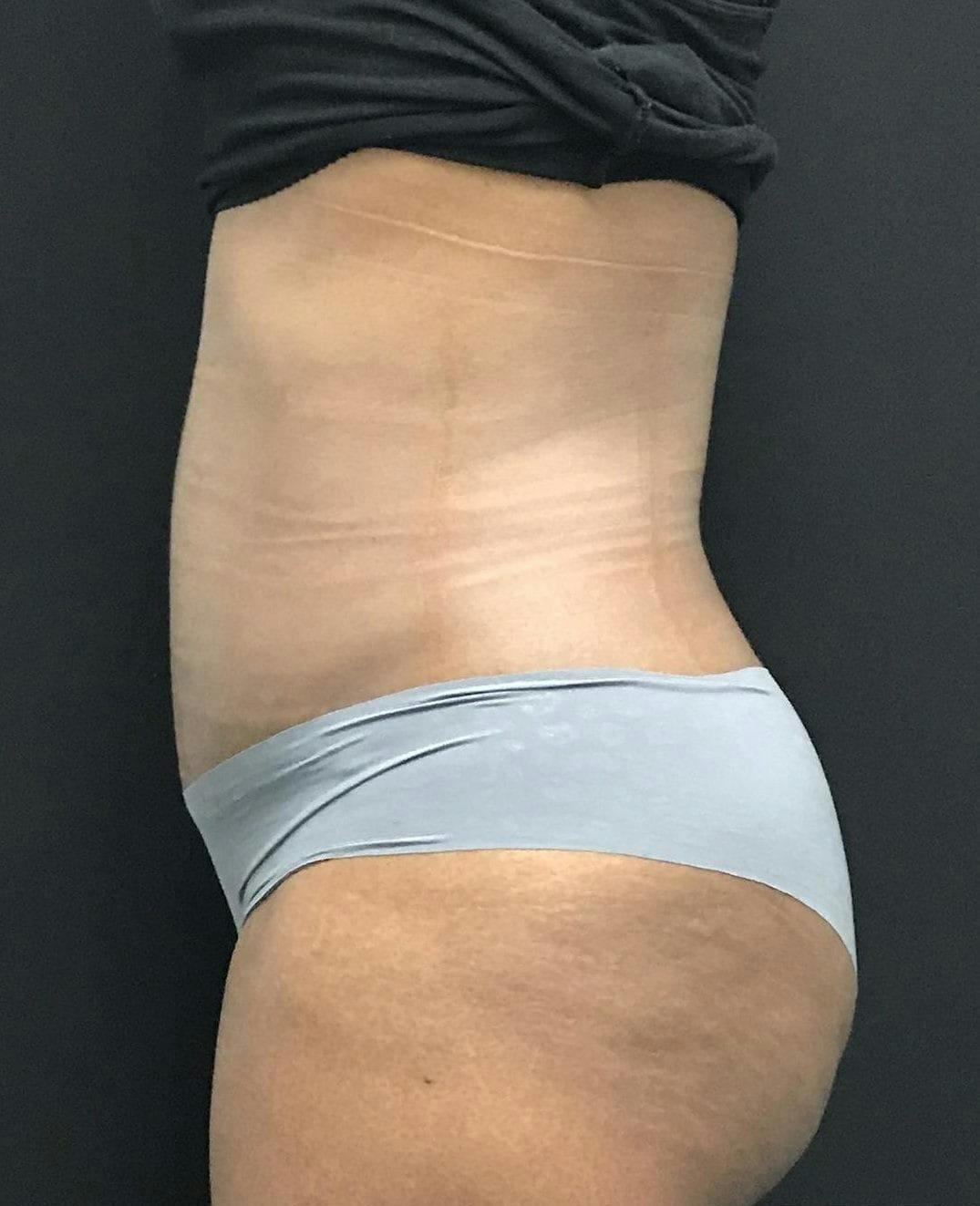 Tummy Tuck Before & After Gallery - Patient 151521125 - Image 6