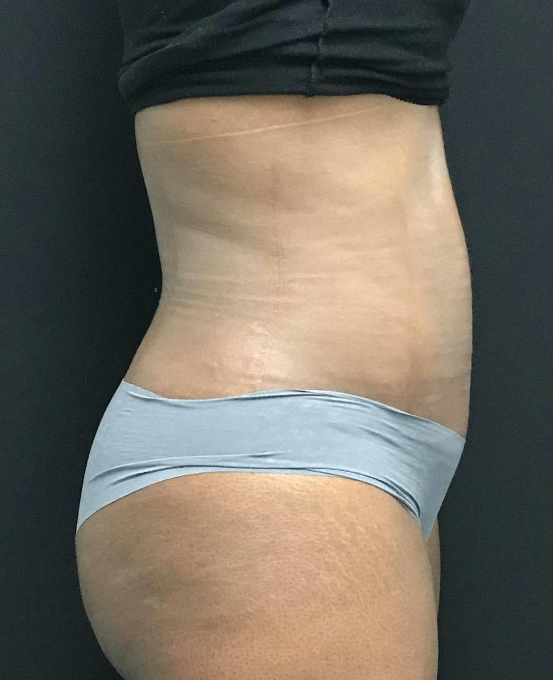 Tummy Tuck Before & After Gallery - Patient 151521125 - Image 8