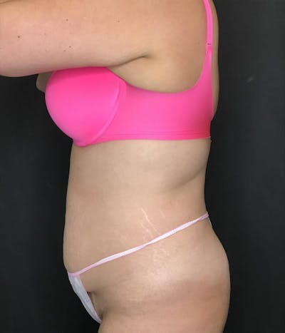 Tummy Tuck Before & After Gallery - Patient 151521126 - Image 1