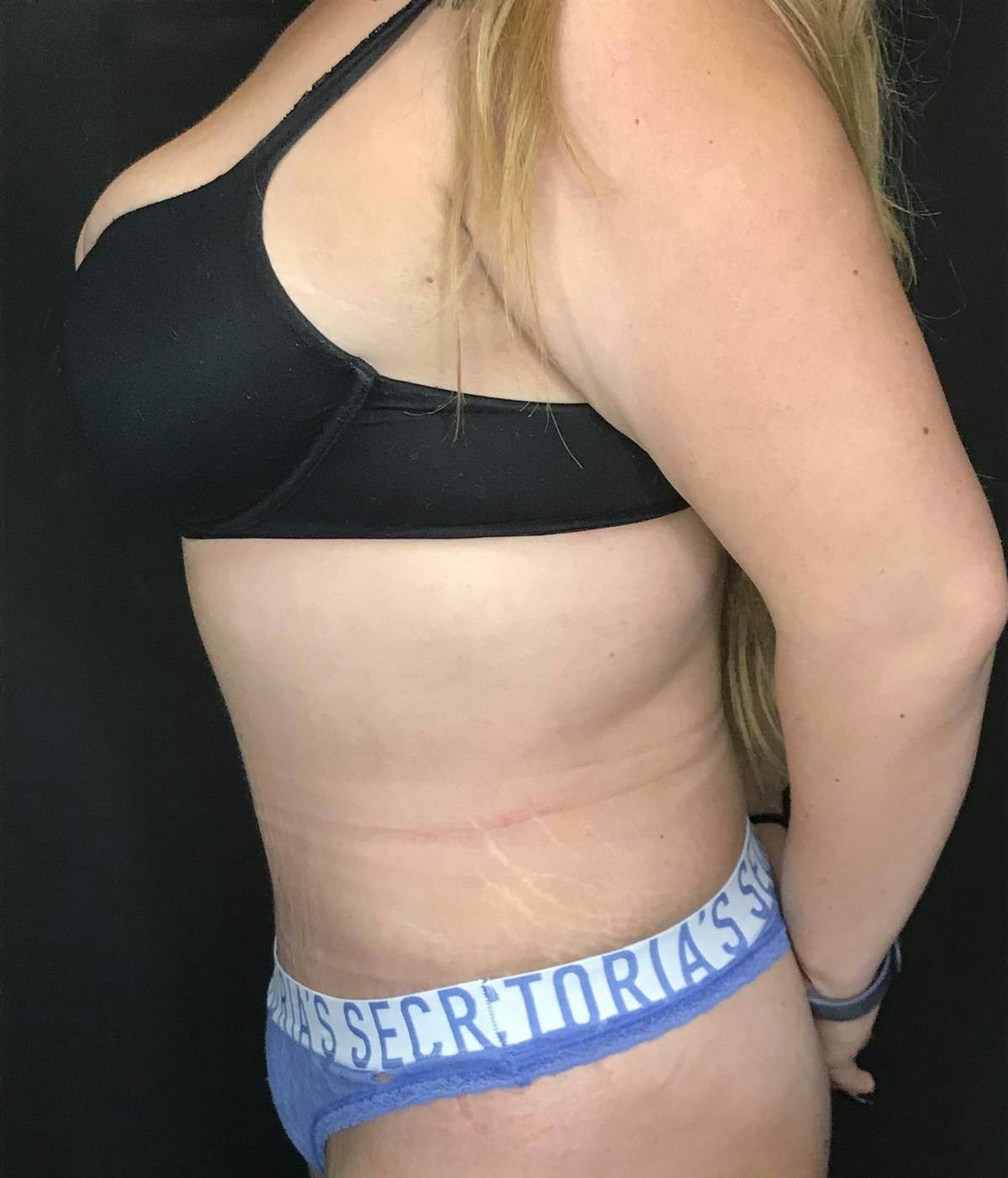 Tummy Tuck Before & After Gallery - Patient 151521126 - Image 4