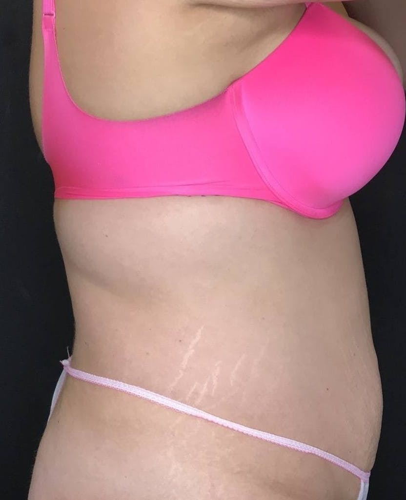 Tummy Tuck Before & After Gallery - Patient 151521126 - Image 3