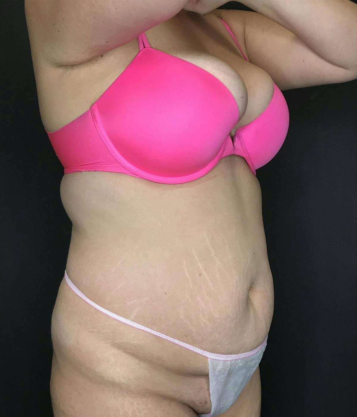 Tummy Tuck Before & After Gallery - Patient 151521126 - Image 5