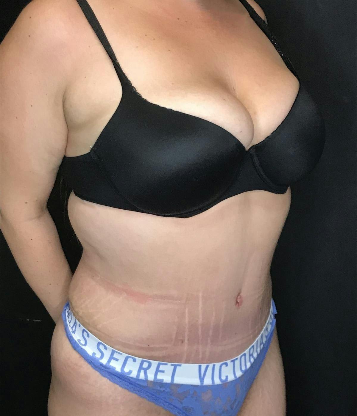 Tummy Tuck Before & After Gallery - Patient 151521126 - Image 6