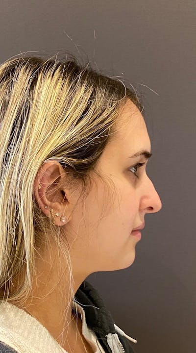 Rhinoplasty Before & After Gallery - Patient 151510792 - Image 1