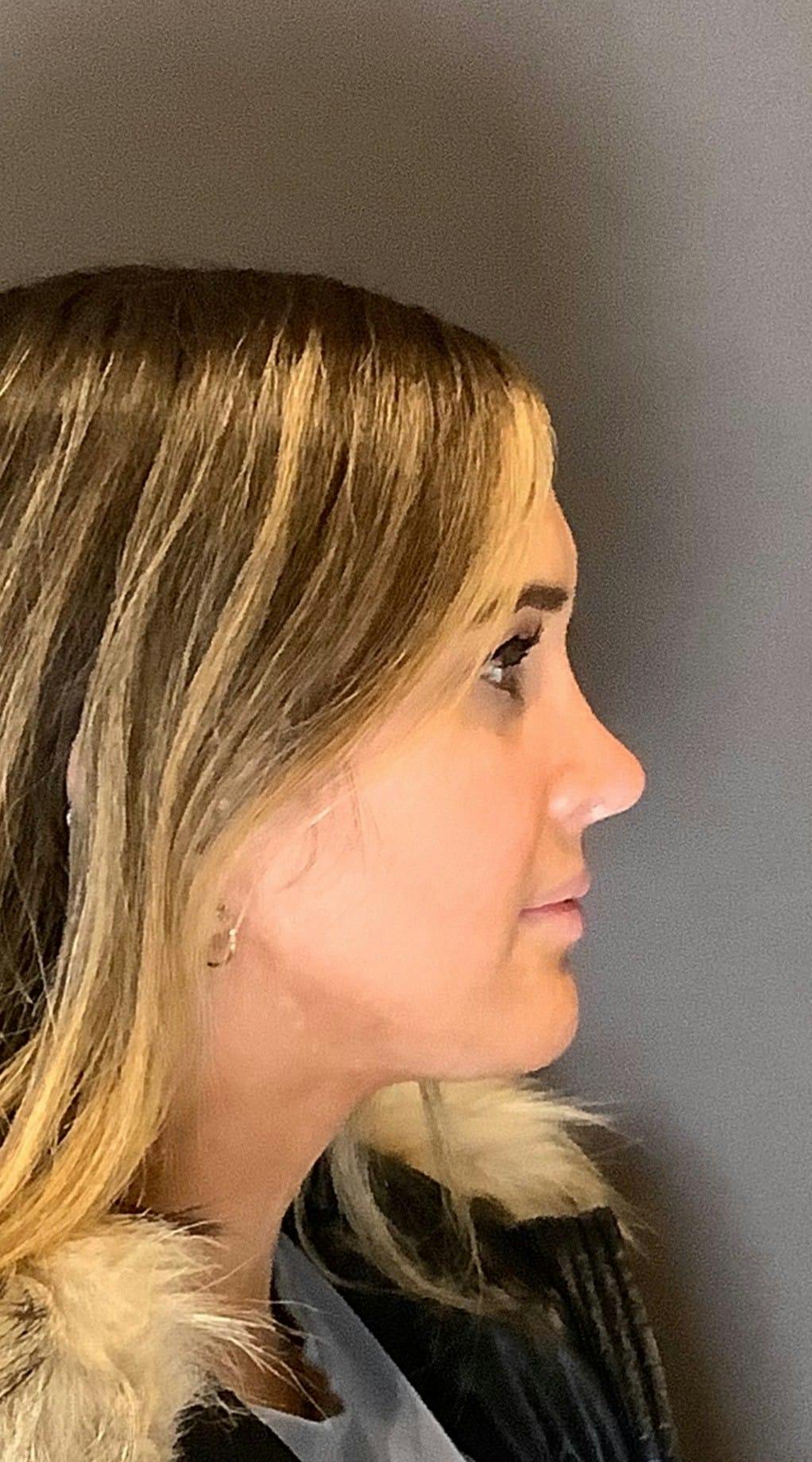 Rhinoplasty Before & After Gallery - Patient 151510792 - Image 2