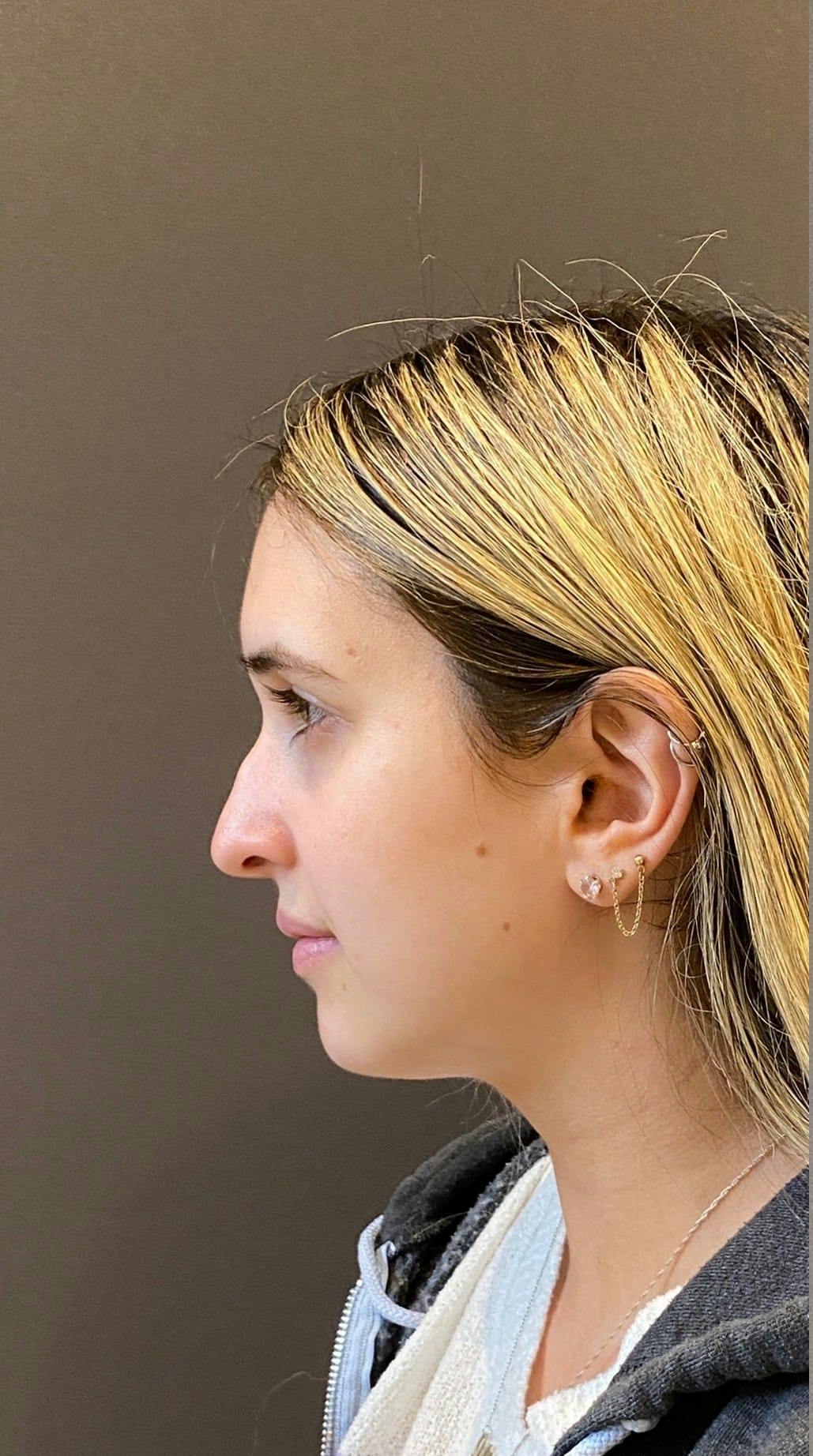 Rhinoplasty Before & After Gallery - Patient 151510792 - Image 7