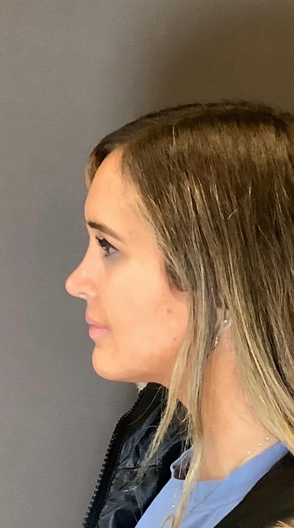 Rhinoplasty Before & After Gallery - Patient 151510792 - Image 8