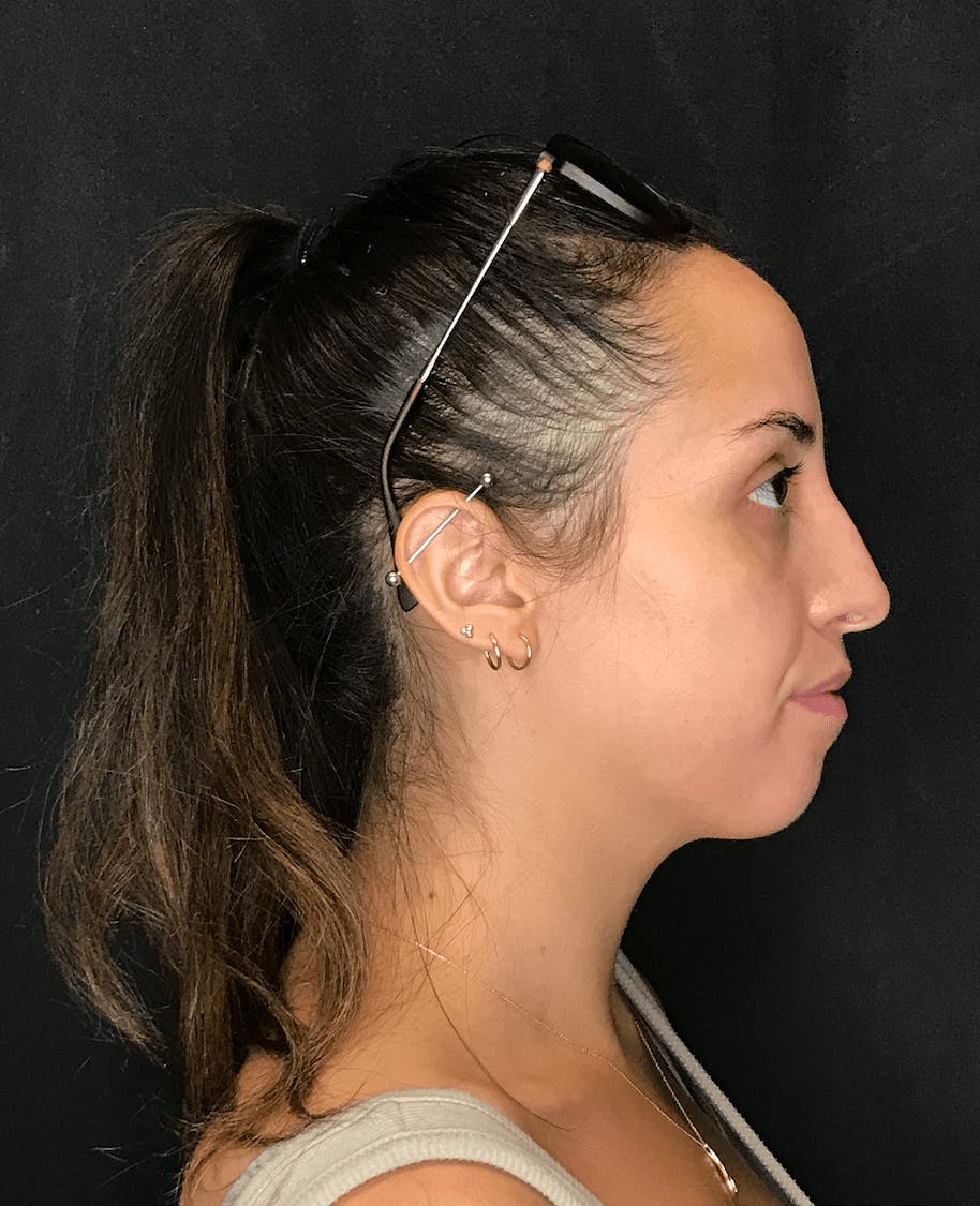 Rhinoplasty Before & After Gallery - Patient 151510785 - Image 1
