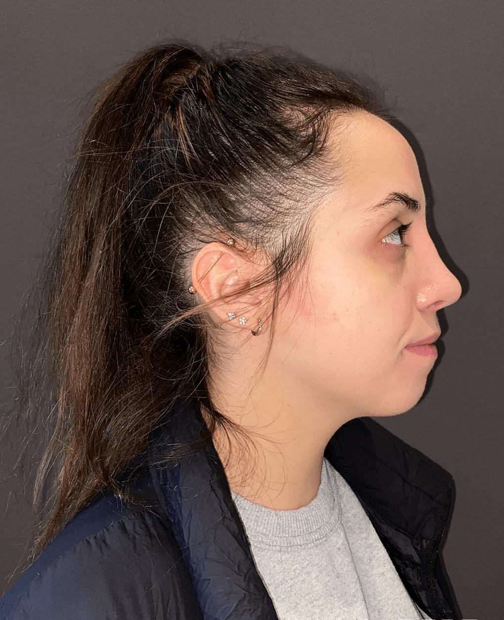 Rhinoplasty Before & After Gallery - Patient 151510785 - Image 2