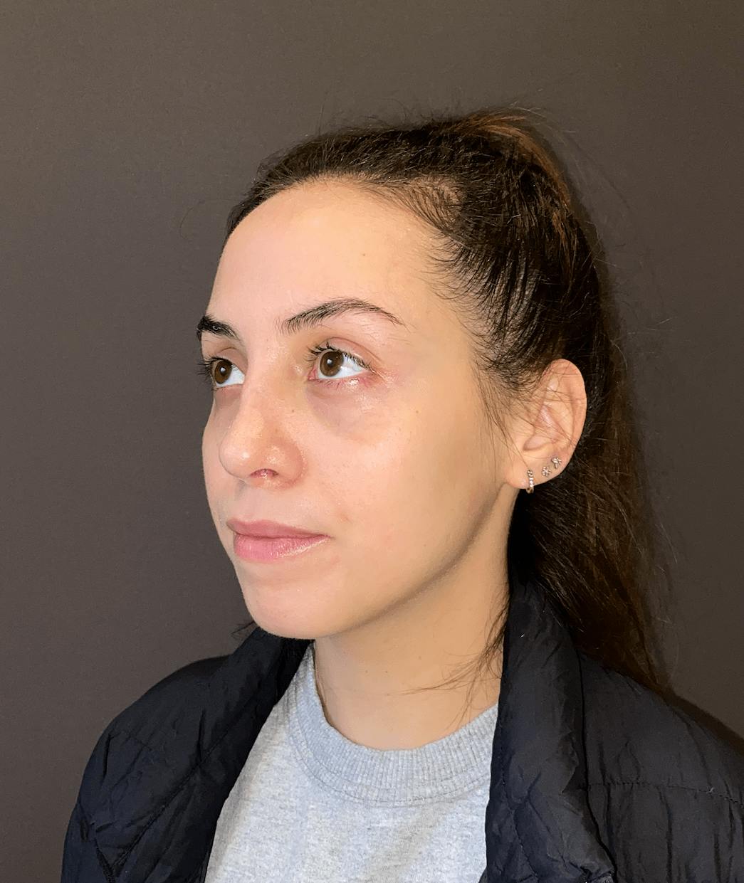 Rhinoplasty Before & After Gallery - Patient 151510785 - Image 6