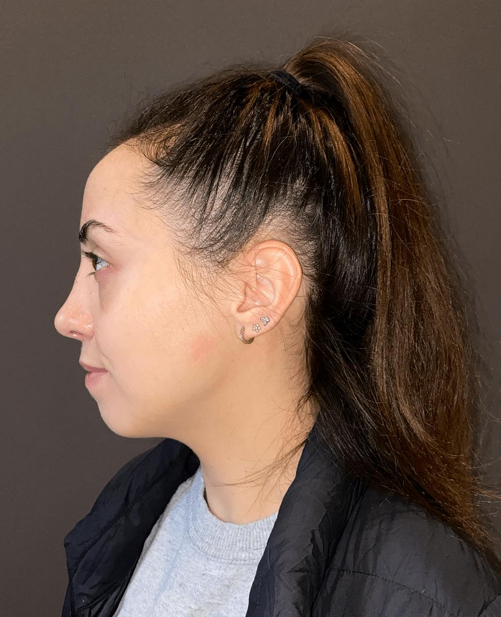 Rhinoplasty Before & After Gallery - Patient 151510785 - Image 8