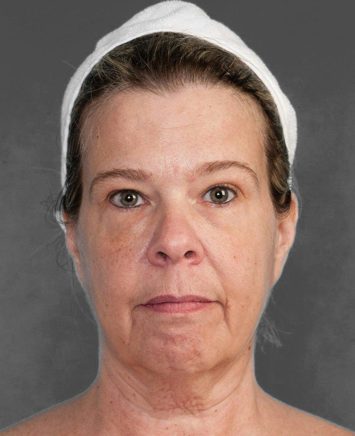 Facelift & Necklift before in NYC front view p#3