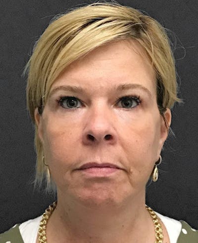 Facelift / Necklift Before & After Gallery - Patient 151452109 - Image 2